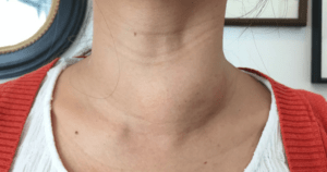 Увеличенные лимфоузлы на шее – основные симптомы, эффективные методики терапии
